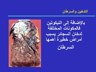 ‫والسرطان‬ ‫التدخين‬
‫النيكوتي‬ ‫إلى‬ ‫باإلضافة‬
‫ن‬
‫المختلفة‬ ‫فالمكونات‬
‫يسبب‬ ‫السجائر‬ ‫لدخان‬
‫أهمها‬ ‫خطيرة‬ ‫أمراض‬
‫السرطان‬
 