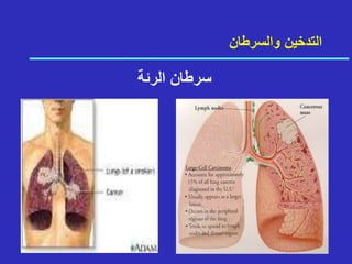 ‫والسرطان‬ ‫التدخين‬
‫س‬
‫ر‬
‫ط‬
‫ا‬
‫ن‬
‫ا‬
‫ل‬
‫ر‬
‫ئ‬
‫ة‬
 