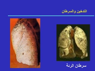 ‫والسرطان‬ ‫التدخين‬
‫س‬
‫ر‬
‫ط‬
‫ا‬
‫ن‬
‫ا‬
‫ل‬
‫ر‬
‫ئ‬
‫ة‬
 