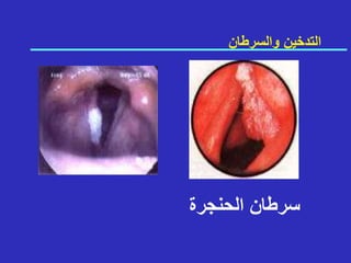 ‫الحنجرة‬ ‫سرطان‬
‫والسرطان‬ ‫التدخين‬
 
