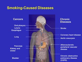 Smoking-Caused Diseases
Cancers
Lung
Larynx
Esophagus
Bladder
Kidney and
Ureter
Pancreas
Oral pharynx
Stroke
Coronary heart disease
Aortic aneurysm
Atherosclerotic
peripheral vascular
disease
Chronic obstructive
pulmonary disease
(COPD)
Chronic
Diseases
 