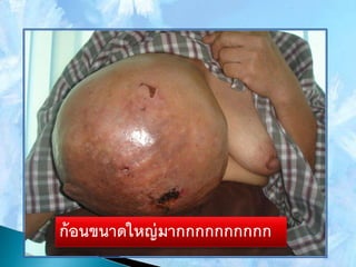 ก้อนขนาดใหญ่มากกกกกกกกกก
 