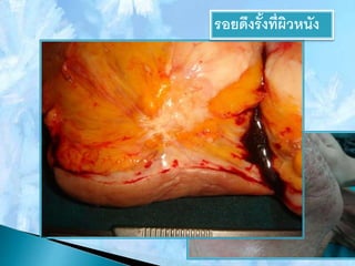 รอยดึงรั้งที่ผิวหนัง
 