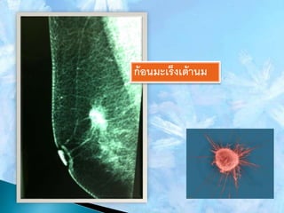 ก้อนมะเร็งเต้านม
 