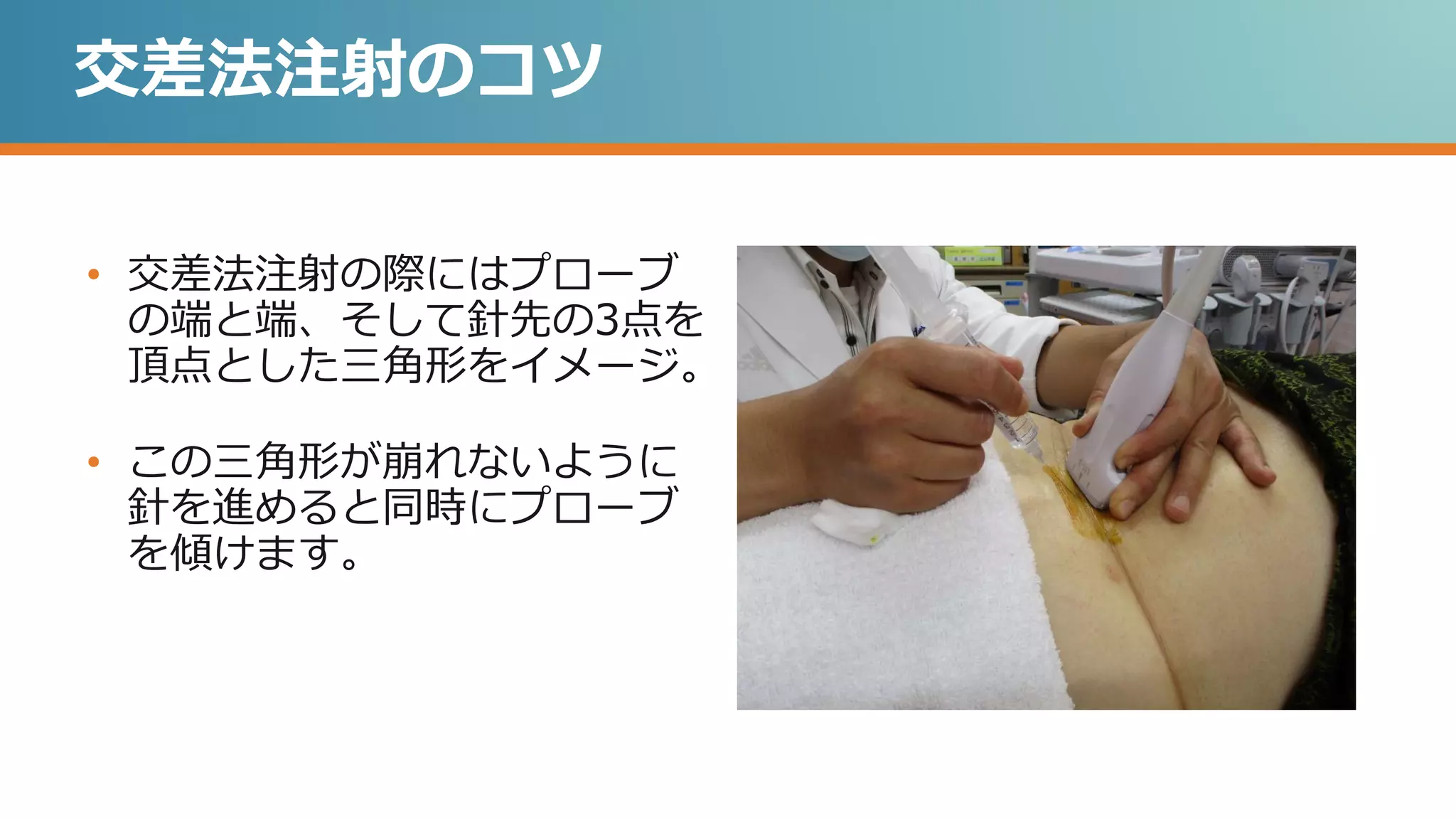 交差法注射のコツ
• 交差法注射の際にはプローブ
の端と端、そして針先の3点を
頂点とした三角形をイメージ。
• この三角形が崩れないように
針を進めると同時にプローブ
を傾けます。
 