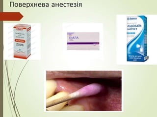 Поверхнева анестезія
 
