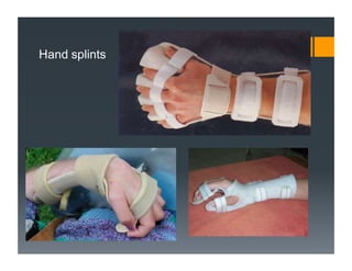 Hand splints
 