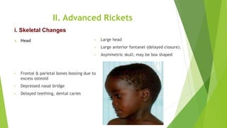 II. Advanced Rickets
1. Head • Large head
• Large anterior fontanel (delayed closure).
• Asymmetric skull; may be box shaped
• Frontal & parietal bones bossing due to
excess osteoid
• Depressed nasal bridge
• Delayed teething, dental caries
i. Skeletal Changes
 