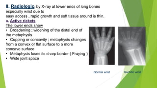 II. Radiologic: by X-ray at lower ends of long bones
especially wrist due to
easy access , rapid growth and soft tissue around is thin.
a. Active rickets
The lower ends show
• Broadening ; widening of the distal end of
the metaphysis
• Cupping or concavity ; metaphysis changes
from a convex or flat surface to a more
concave surface
• Metaphysis loses its sharp border ( Fraying )
• Wide joint space
Normal wrist Rachitic wrist
 