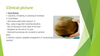 Clinical picture
I. Early Rickets
1- Anorexia, irritability, & sweating of forehead
2- Craniotabes
- Skull bones yield under pressure 
Ping - pong or egg shell crackling sensation.
- Due to thinning of inner table of the skull
- Disappear by the end of 1st year.
- Detected by pressing over occipital or parietal
bone
3- Rachitic rosaries: palpable enlargement of costochondral junctions (excess
osteoid)
 