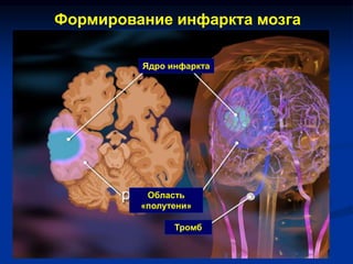 Формирование инфаркта мозга
Ядро инфаркта
Область
«полутени»
Тромб
 