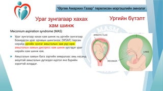 “Өргөө Амаржих Газар” төрөлжсөн мэргэшлийн эмнэлэг
Ураг зунгагаар хахах
хам шинж
Meconium aspiration syndrome (MAS)
 Ураг зунгагаар хахах хам шинж нь ургийн зунгагаар
бохирдсон ураг орчмын шингэнээс (MSAF) төрсөн
нярайд ургийн зунгаг амьсгалын зам руу орж
амьсгалын замын дистресс хам шинж үүсгэдэг ураг
нярайн хам шинж юм.
 Амьсгалын замын бага зэргийн хямралаас амь насанд
аюултай амьсгалын дутагдал хүртэл янз бүрийн
зэрэгтэй илэрдэг.
Ургийн бүтэлт
 