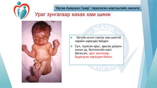 “Өргөө Амаржих Газар” төрөлжсөн мэргэшлийн эмнэлэг
Ураг зунгагаар хахах хам шинж
 Ургийн өсөлт саатах хам шинтэй
нярайн харагдах байдал
 Сул, гуужсан арьс, арьсан доорхи
өөхөн эд, булчингийн масс
багассан, ураг зунгагаар
будагдсан харагдаж байна.
 