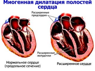 Миогенная дилатация полостей
сердца
 