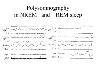 Polysomnography
in NREM and REM sleep
 
