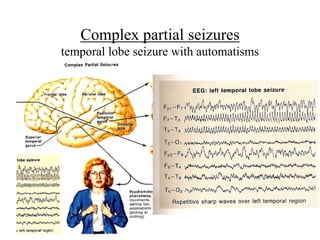 Complex partial seizures
temporal lobe seizure with automatisms
 