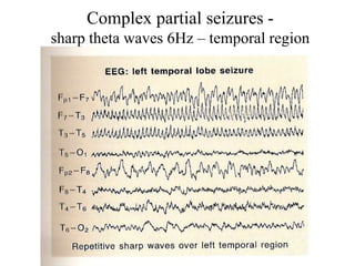 Complex partial seizures -
sharp theta waves 6Hz – temporal region
 
