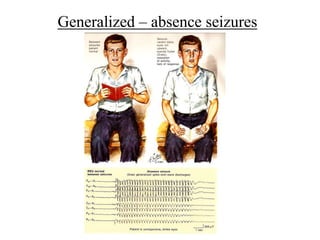 Generalized – absence seizures
 