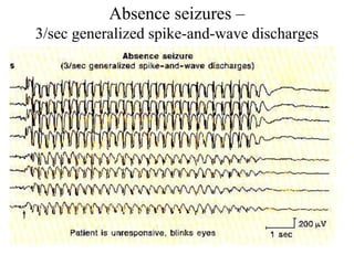 Absence seizures –
3/sec generalized spike-and-wave discharges
 