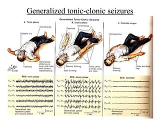 Generalized tonic-clonic seizures
 