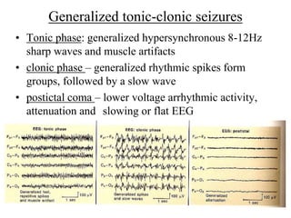 Generalized tonic-clonic seizures
• Tonic phase: generalized hypersynchronous 8-12Hz
sharp waves and muscle artifacts
• cl...