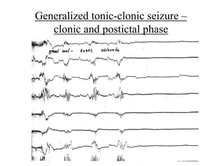 Generalized tonic-clonic seizure –
clonic and postictal phase
 