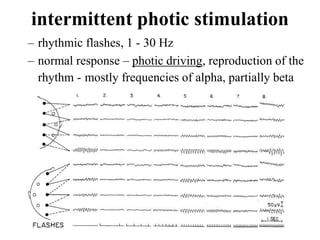 intermittent photic stimulation
– rhythmic flashes, 1 - 30 Hz
– normal response – photic driving, reproduction of the
rhyt...