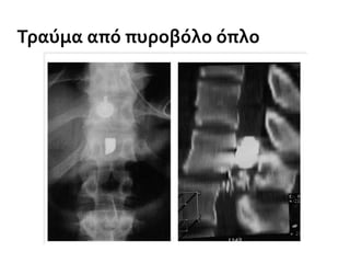 Τραύμα από πυροβόλο όπλο
 