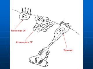 Типичная ЭГ
Атипичная ЭГ
Таницит
 