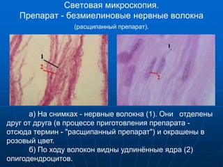 Световая микроскопия.
Препарат - безмиелиновые нервные волокна
(расщипанный препарат).
а) На снимках - нервные волокна (1). Они отделены
друг от друга (в процессе приготовления препарата -
отсюда термин - "расщипанный препарат") и окрашены в
розовый цвет.
б) По ходу волокон видны удлинённые ядра (2)
олигодендроцитов.
 