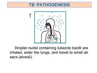 TB PATHOGENESIS
Droplet nuclei containing tubercle bacilli are
inhaled, enter the lungs, and travel to small air
sacs (alveoli) .
 