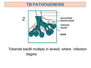 TB PATHOGENESIS
bronchiole
blood vessel
tubercle
bacilli
alveoli
2
Tubercle bacilli multiply in alveoli, where infection
begins
 