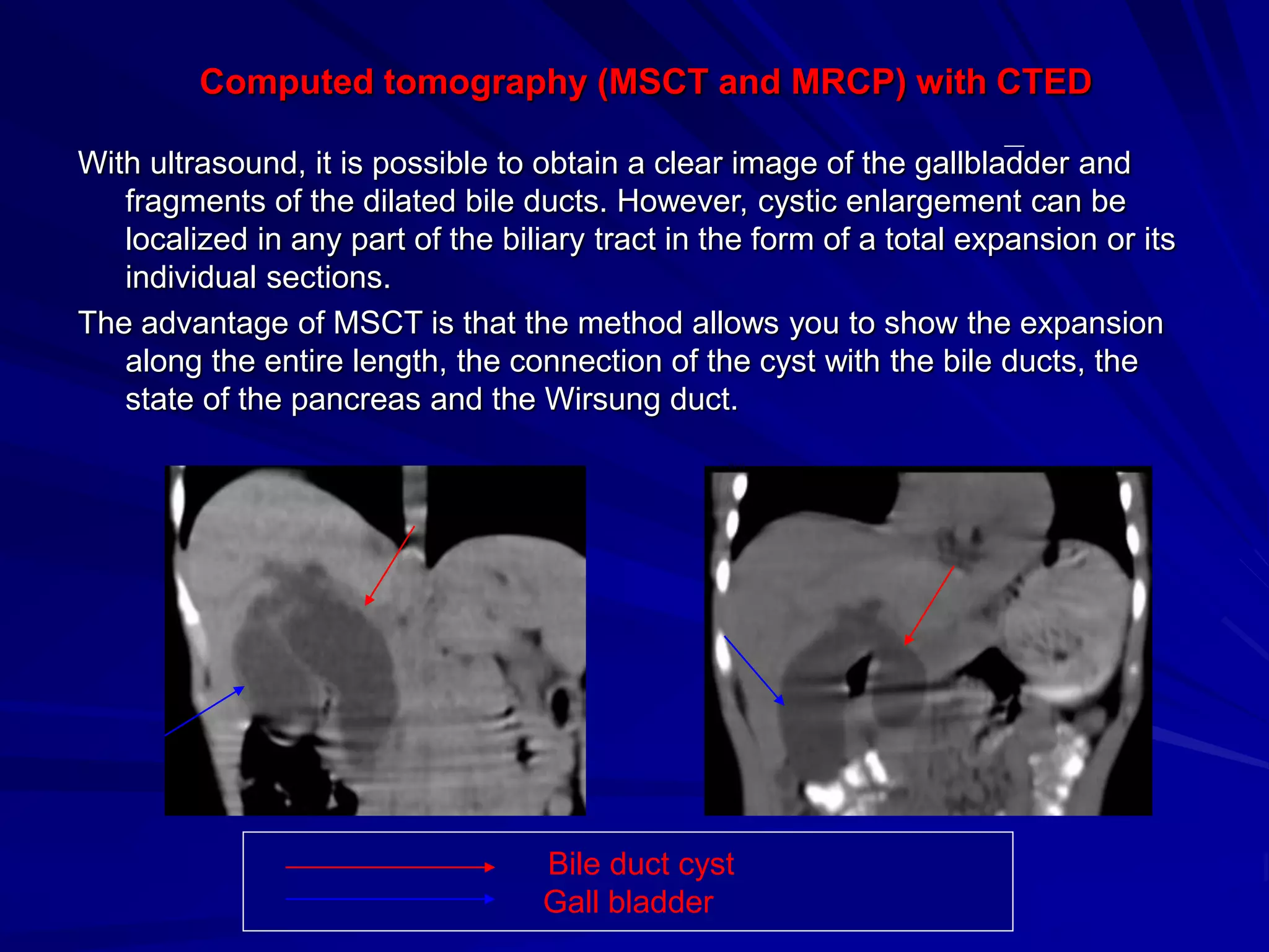 Malformations of the biliary tract. Portal hypertension syndrome ...