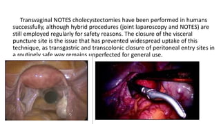 Transvaginal NOTES cholecystectomies have been performed in humans
successfully, although hybrid procedures (joint laparoscopy and NOTES) are
still employed regularly for safety reasons. The closure of the visceral
puncture site is the issue that has prevented widespread uptake of this
technique, as transgastric and transcolonic closure of peritoneal entry sites in
a routinely safe way remains unperfected for general use.
 