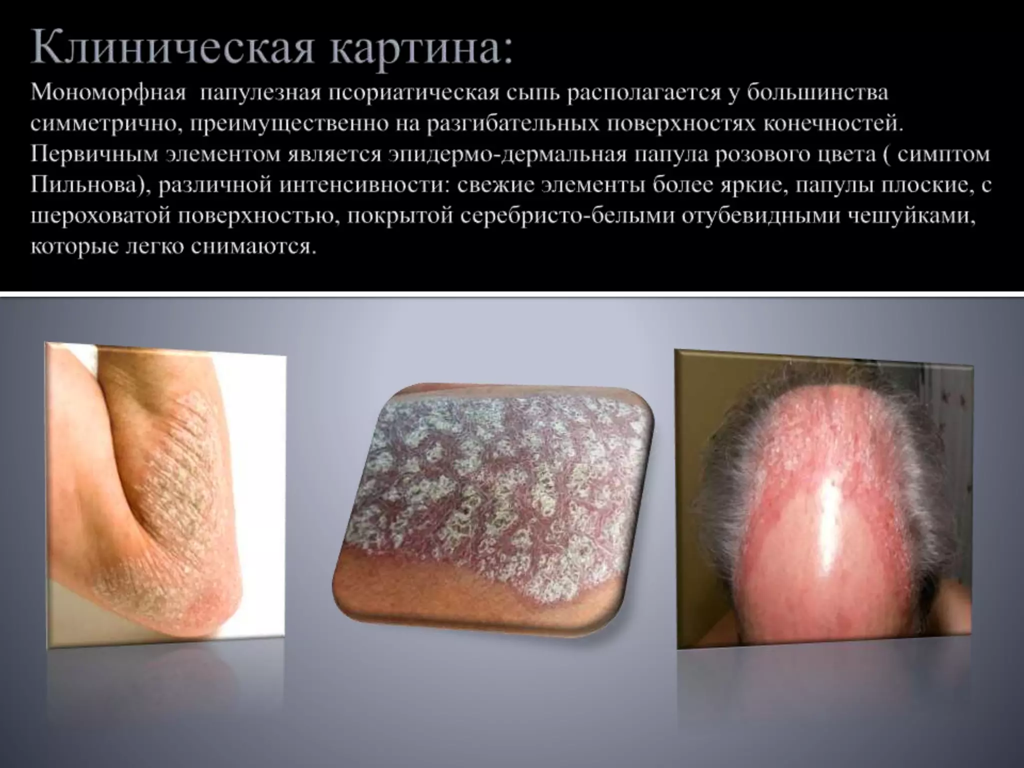 Псориаз.pptx