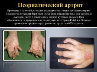 Псориаз.pptx