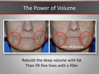 The Power of Volume
After fat grafting
Rebuild the deep volume with fat
Then fill fine lines with a filler
 