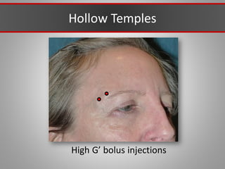 Hollow Temples
High G’ bolus injections
 