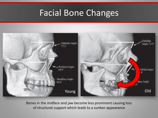 Facial Bone Changes
Young Old
Bones in the midface and jaw become less prominent causing loss
of structural support which leads to a sunken appearance
 
