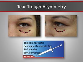 Tear Trough Asymmetry
Topical anesthetic
Restylane (Moderate G’)
30G needle
80% correction
 
