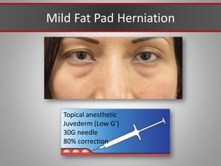 Mild Fat Pad Herniation
Topical anesthetic
Juvederm (Low G’)
30G needle
80% correction
 