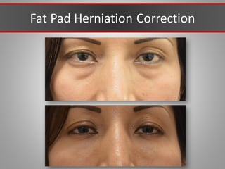 Fat Pad Herniation Correction
 