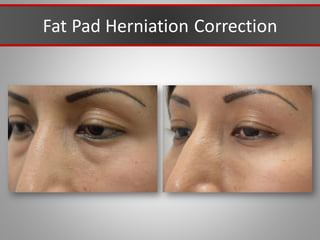 Fat Pad Herniation Correction
 