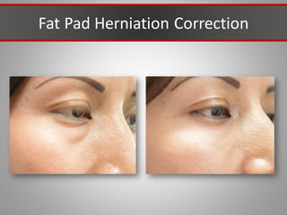 Fat Pad Herniation Correction
 