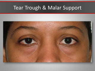 Tear Trough & Malar Support
 