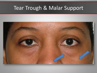 Tear Trough & Malar Support
 