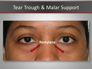Tear Trough & Malar Support
Restylane
 
