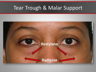 Tear Trough & Malar Support
Restylane
Radiesse
 