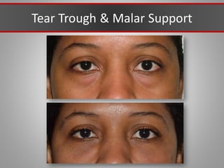 Tear Trough & Malar Support
 