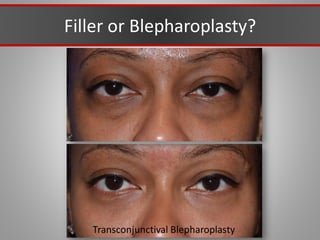 Filler or Blepharoplasty?
Transconjunctival Blepharoplasty
 
